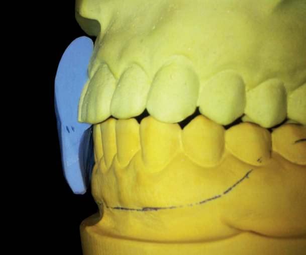 Nowoczesne Ochrony Łuków Zębowych w Sporcie – Rewolucja w Technologii Pressing Dental